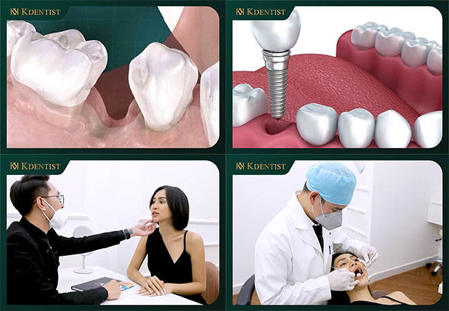 Trồng răng implant ở quảng ngãi Trồng răng implant ở quảng ngãi