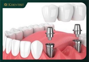Sau khi nhổ răng 3 - 4 tháng tiến hành cấy ghép implant