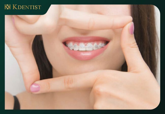 Niềng răng uy tín ở quảng ngãi