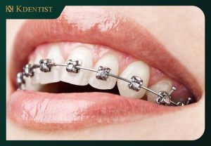 Niềng răng mắc cài kim loại Niềng răng mắc cài kim loại