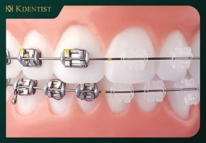 Giá niềng răng mắc cài kim loại tự đóng tháo lắp Giá niềng răng mắc cài kim loại tự đóng tháo lắp