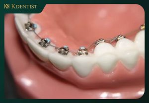 Giá niềng răng mắc cài lắp mặt trong Giá niềng răng mắc cài lắp mặt trong