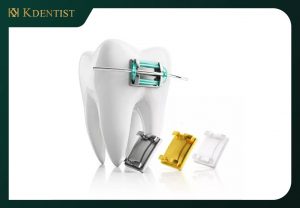 Giá niềng răng mắc cài sứ tự đóng Giá niềng răng mắc cài sứ tự đóng