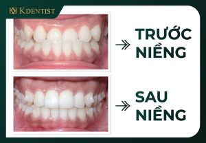 Niềng răng tại nha khoa Niềng răng tại nha khoa