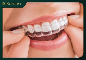 Giá niềng răng không mắc cài invisalign Giá niềng răng không mắc cài invisalign