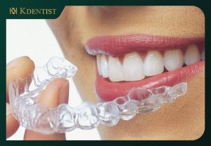 phương pháp niềng răng hiệu quả và tiết kiệm chi phí phương pháp niềng răng hiệu quả và tiết kiệm chi phí