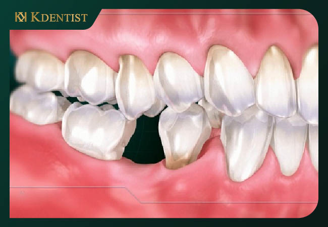 Áp dụng được hết các trường hợp mất răng Áp dụng được hết các trường hợp mất răng