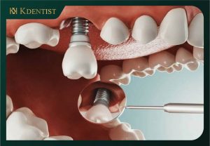 Sau khi nhổ răng tiến hành cấy ghép implant ngay