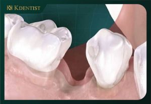 Sau khi nhổ răng bao lâu thì trồng implant được?