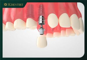 Sau khi nhổ răng 1 - 2 tháng tiến hành trồng implant