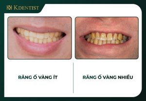 Trường hợp nên tẩy trắng răng Trường hợp nên tẩy trắng răng