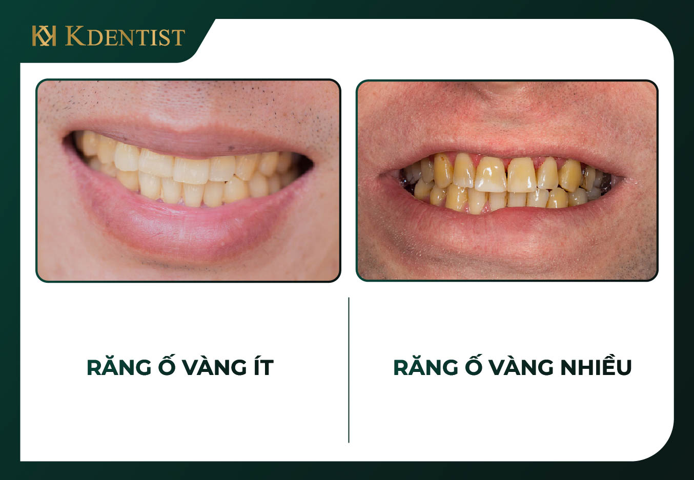 Trường hợp nên tẩy trắng răng