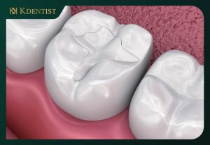 Vật liệu trám răng Amalgam Vật liệu trám răng Amalgam