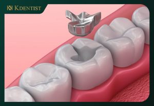 Chọn vật liệu trám răng Chọn vật liệu trám răng