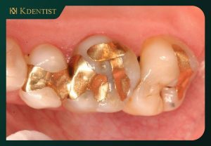 Vật liệu trám răng kim loại quý Vật liệu trám răng kim loại quý