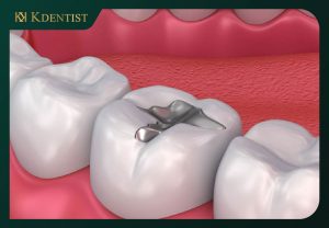Vật liệu trám răng Composite Vật liệu trám răng Composite
