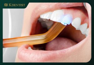 Số lượng răng cần trám Số lượng răng cần trám