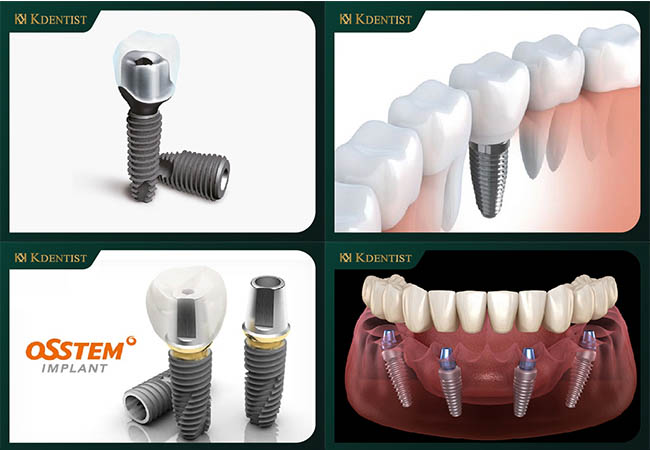 giá trồng răng implant hàn quốc