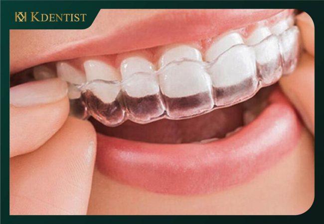 Niềng răng bị thưa với mắc cài trong suốt ( không mắc cài) Niềng răng bị thưa với mắc cài trong suốt ( không mắc cài)
