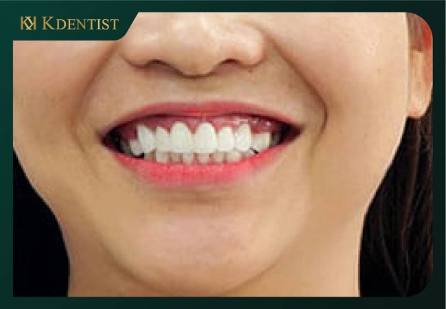 Độ bền cao, đảm bảo chức răng thay thế chân răng tốt Độ bền cao, đảm bảo chức răng thay thế chân răng tốt