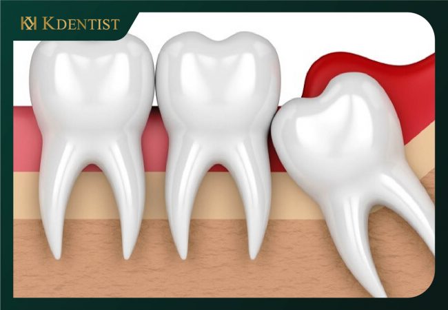 Lợi trùm răng khôn Lợi trùm răng khôn