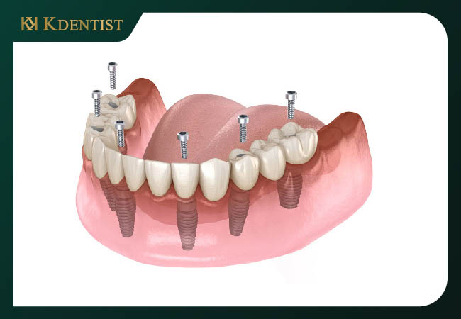 Nhược điểm của cấy ghép implant all on 6 Nhược điểm của cấy ghép implant all on 6