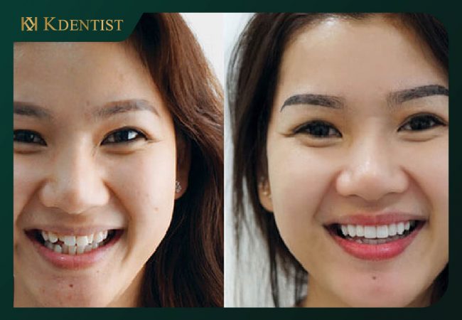 Tăng tính thẩm mỹ cho khuôn mặt Tăng tính thẩm mỹ cho khuôn mặt