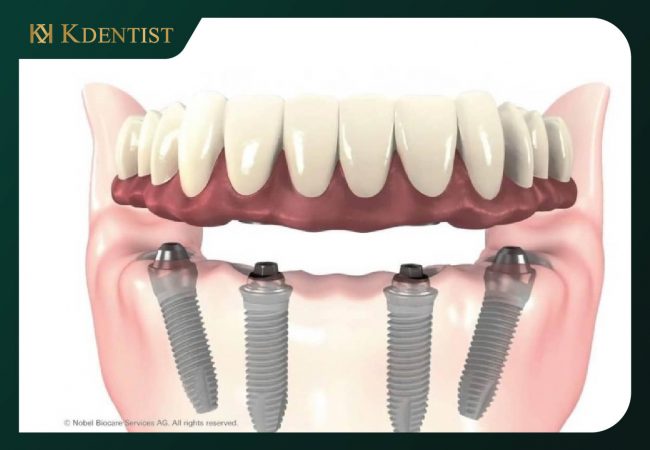 Nhược điểm của cấy ghép implant all on 4 Nhược điểm của cấy ghép implant all on 4