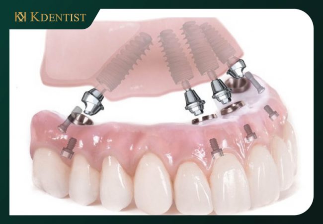 Trồng răng implant all on 4 Trồng răng implant all on 4