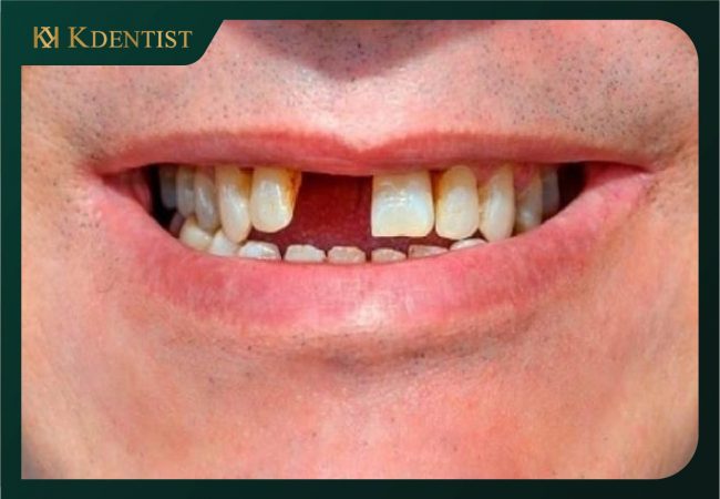 Gây ra hiện tượng mất thêm răng Gây ra hiện tượng mất thêm răng