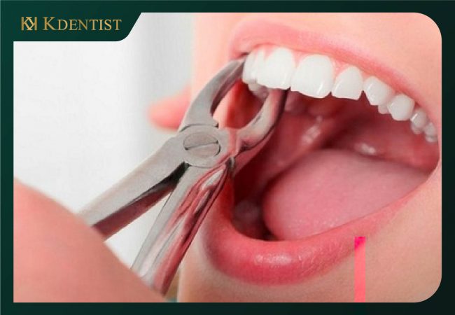 Dịch vụ nhổ răng không đau tại Quảng Ngãi của KDENTIST Dịch vụ nhổ răng không đau tại Quảng Ngãi của KDENTIST