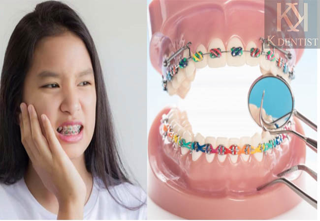 Niềng răng gây Khó chịu trong thời gian đầu Niềng răng gây Khó chịu trong thời gian đầu