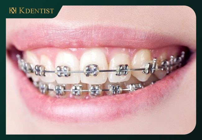 Tác hại của niềng răng Tác hại của niềng răng
