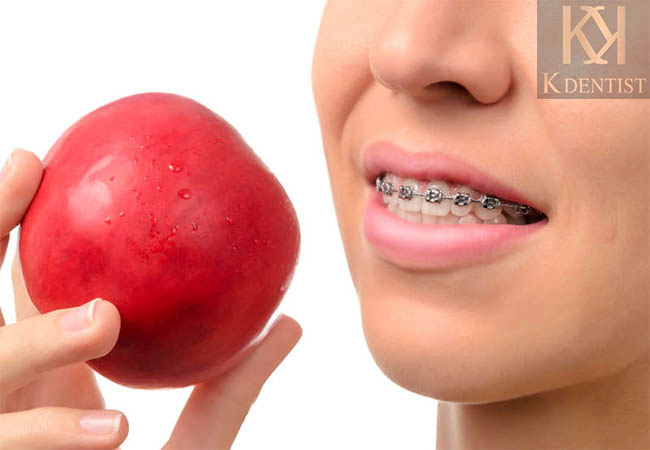 Niềng răng gây Khó khăn trong quá trình ăn uống Niềng răng gây Khó khăn trong quá trình ăn uống