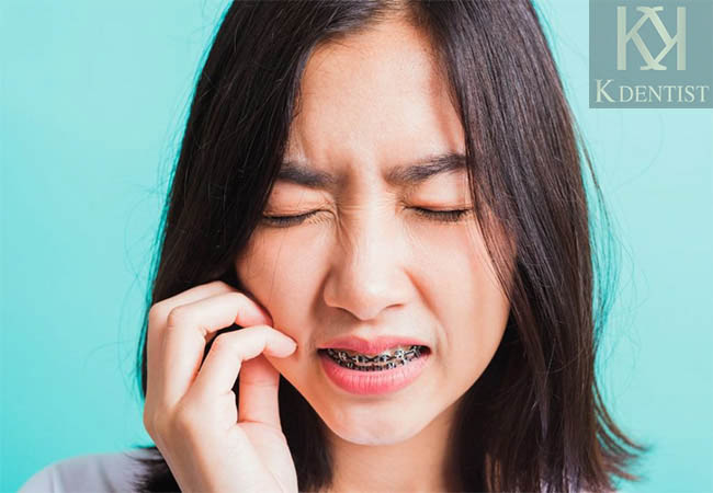 Niềng răng gây đau hàm Niềng răng gây đau hàm