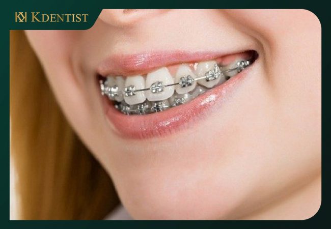 20 Tuổi niềng răng mất bao lâu 20 Tuổi niềng răng mất bao lâu