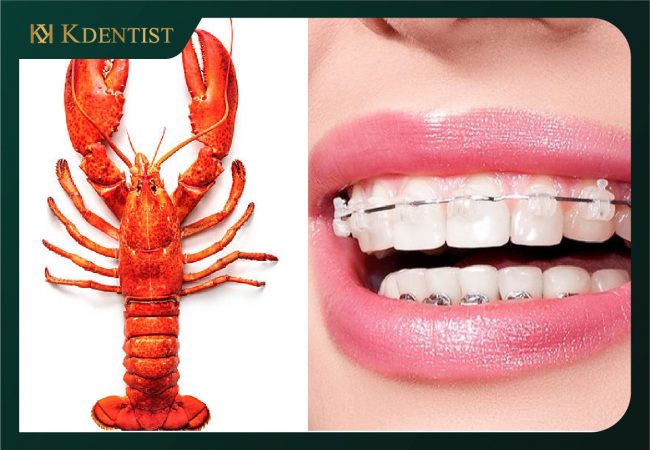 Niềng răng ăn tôm được không Niềng răng ăn tôm được không