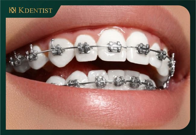Niềng răng bị thưa với mắc cài kim loại Niềng răng bị thưa với mắc cài kim loại