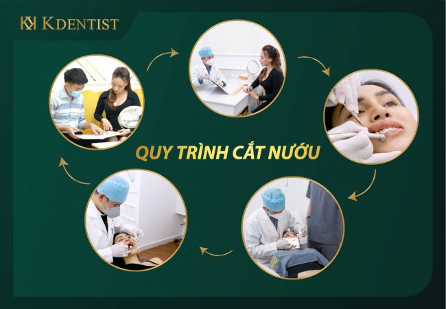 Quy trình cắt lợi bằng laser Quy trình cắt lợi bằng laser