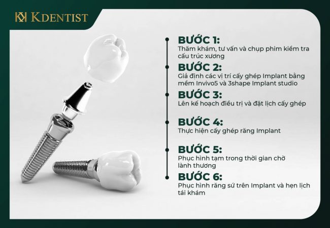 Quy trình trồng cấy ghép implant all on 4 Quy trình trồng cấy ghép implant all on 4