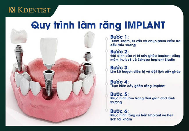Quy trình trồng cấy ghép implant all on 6 Quy trình trồng cấy ghép implant all on 6