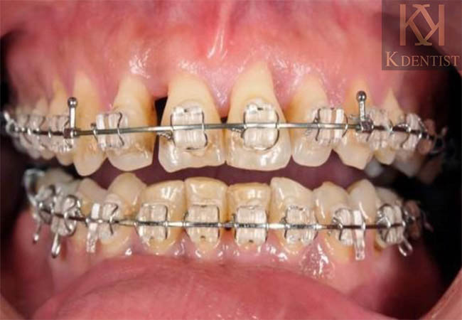 Niềng răng gây ra vấn đề Bị tiêu chân răng Niềng răng gây ra vấn đề Bị tiêu chân răng
