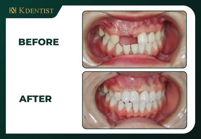 Ưu nhược điểm của cấy ghép implant all on 4 Ưu nhược điểm của cấy ghép implant all on 4
