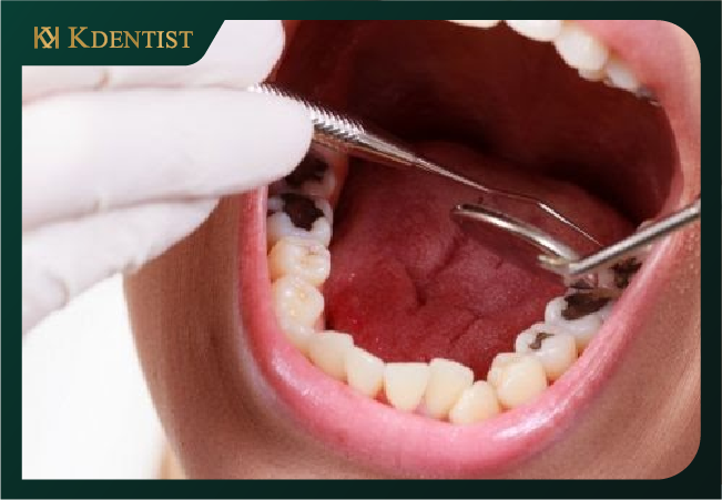 Các lưu ý khi đặt thuốc chữa tủy răng Các lưu ý khi đặt thuốc chữa tủy răng