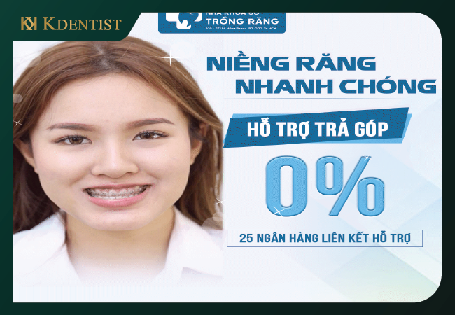 Giới thiệu hình thức niềng răng trả góp tại Kdentist